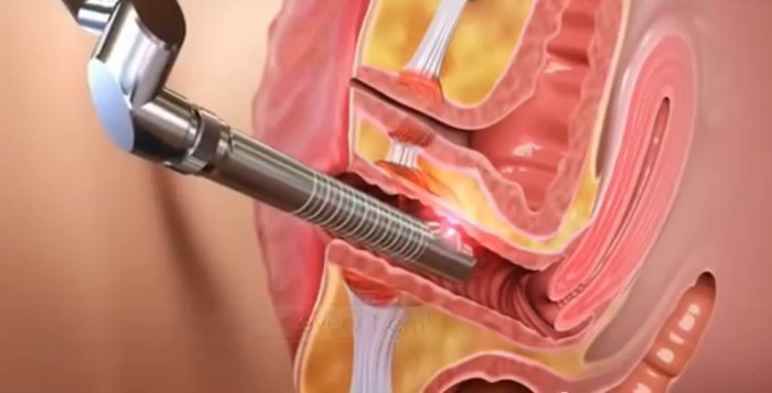Fotona-Laser-Vaginal-Rejuvenation