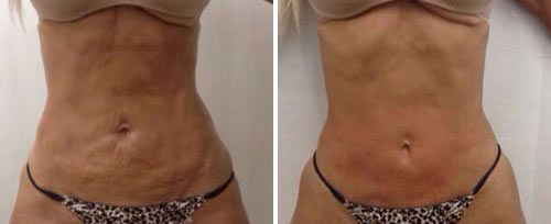 tightsculpting2