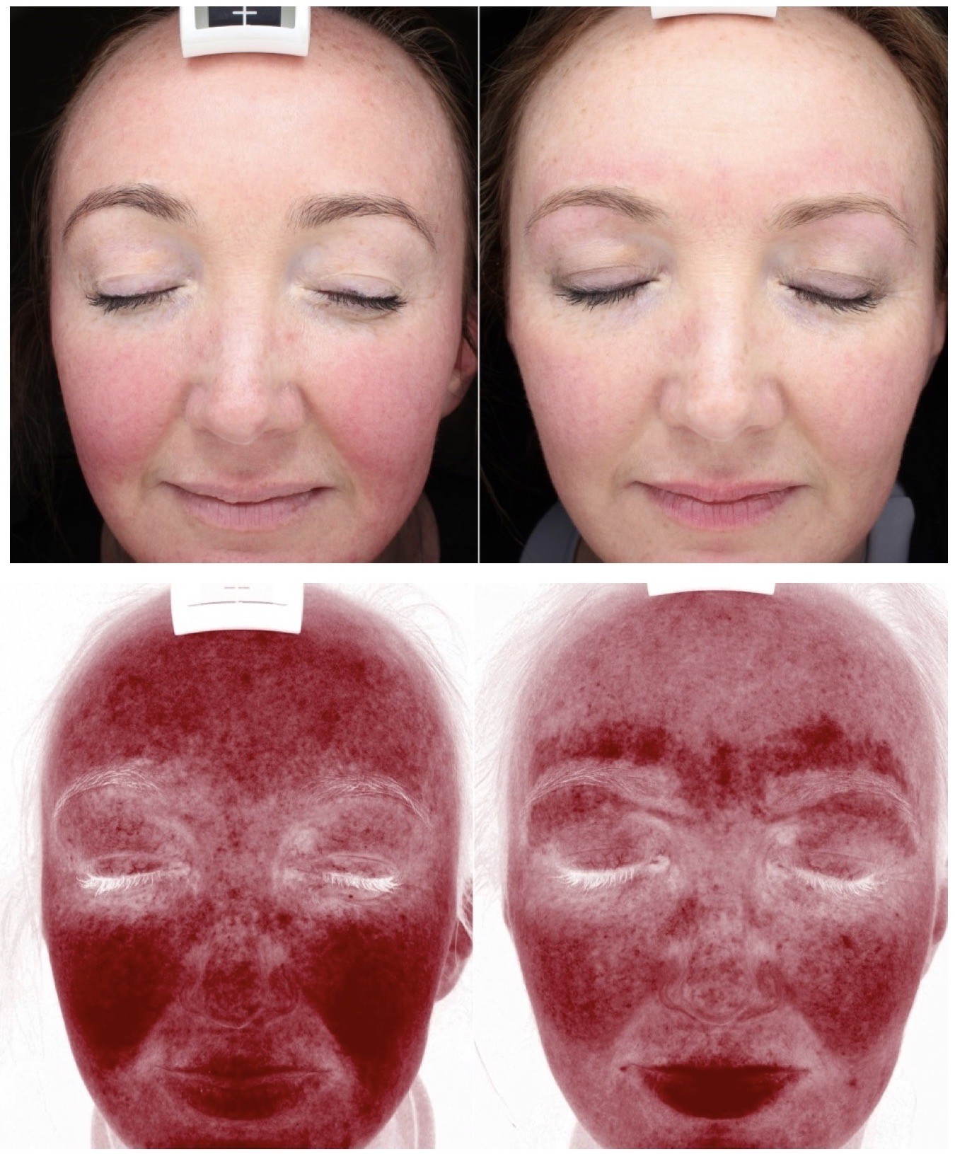 Fotona rosacea